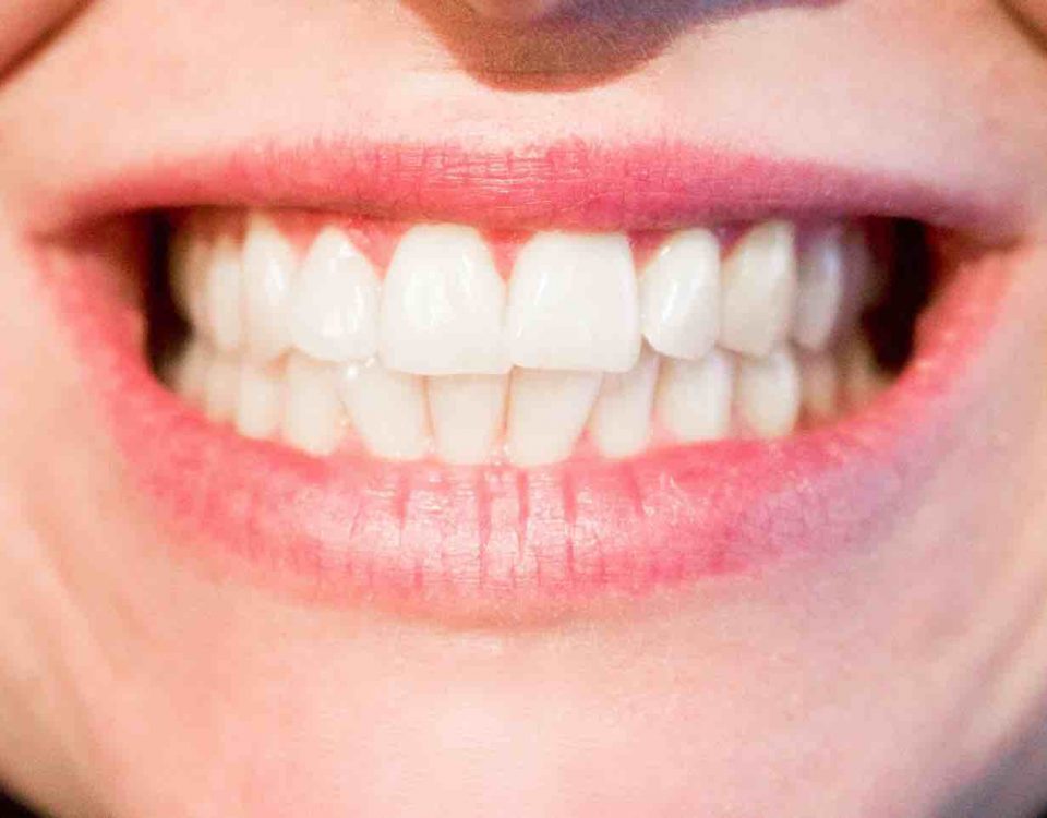 Le Bruxisme aussi appelé grincement des dents