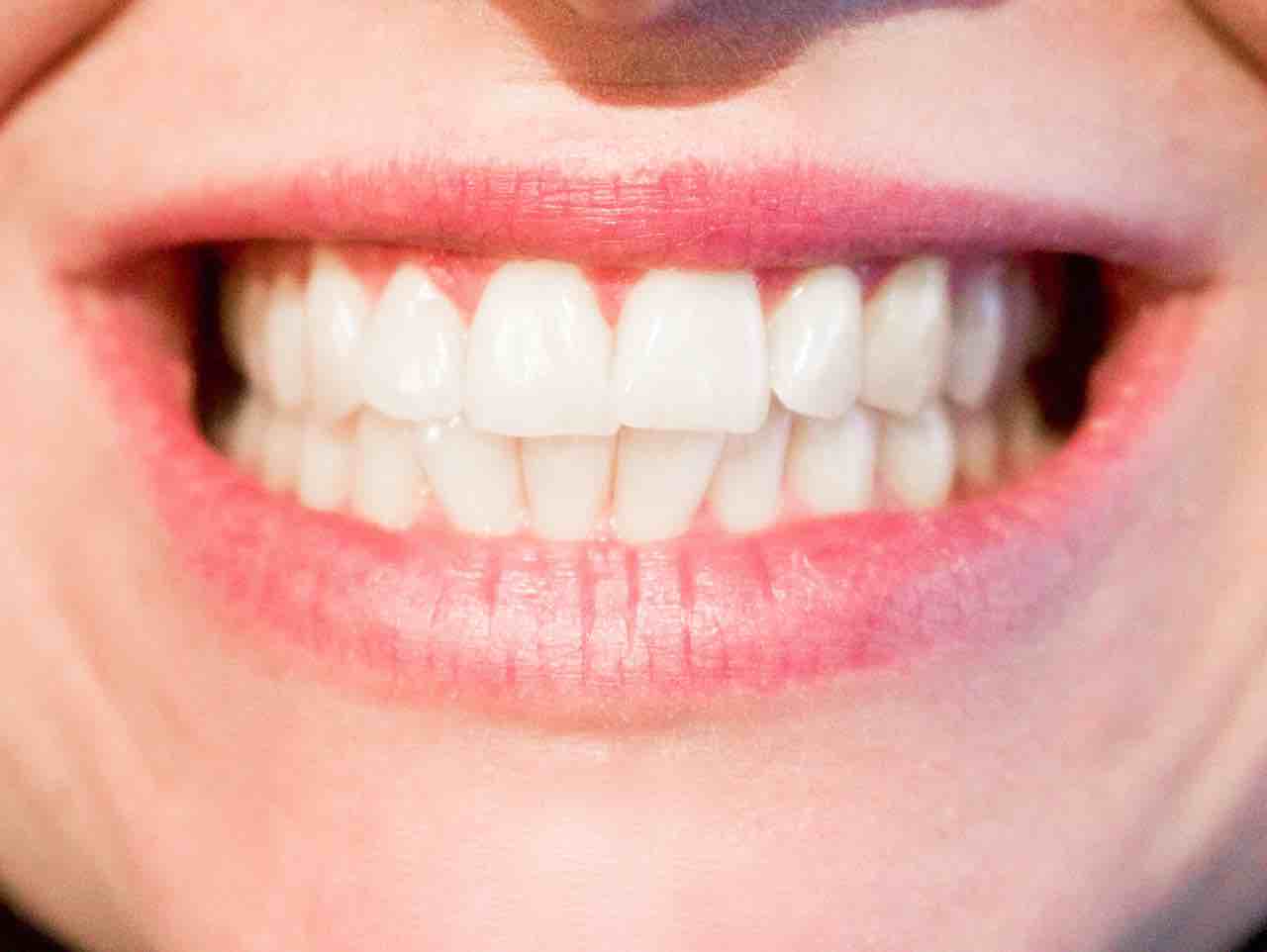 Le Bruxisme aussi appelé grincement des dents