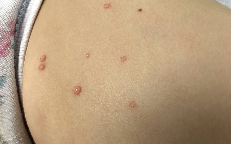 Peau présentant des Molluscum Contagiosum