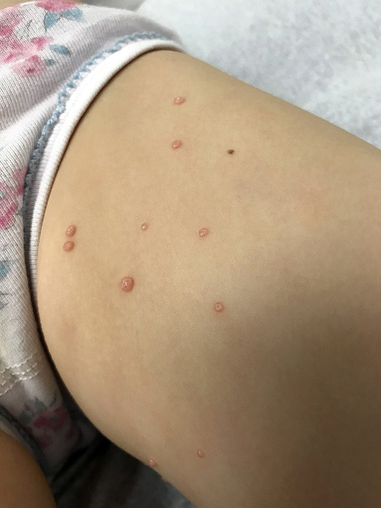 Molluscum contagiosum : l'infection virale à reconnaître et ...