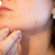 Dermite séborrhéique : causes, symptômes et traitements