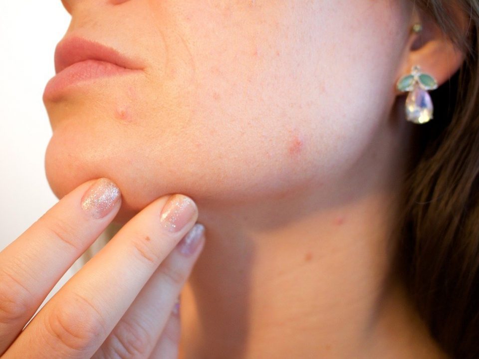 Dermite séborrhéique : causes, symptômes et traitements