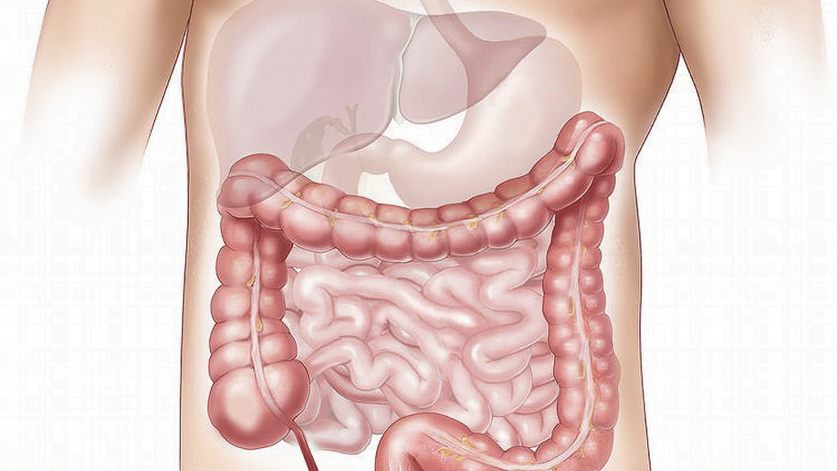 Le gros intestin humain, siège des diverticulites