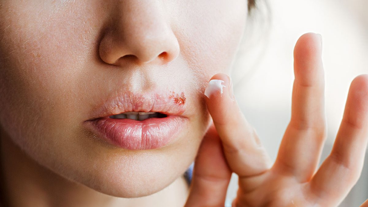 Jeune femme avec un bouton de fièvre