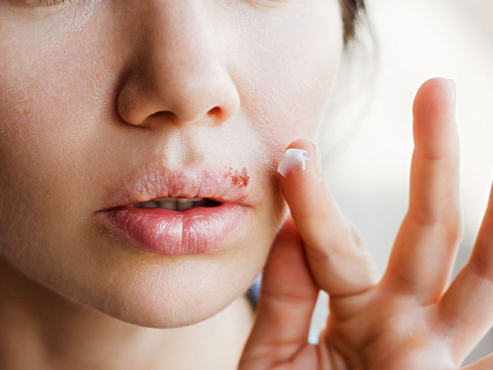 Jeune femme avec un bouton de fièvre
