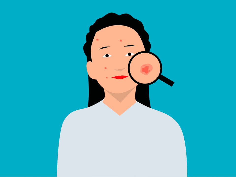 Jeune femme avec quelques boutons d'acné