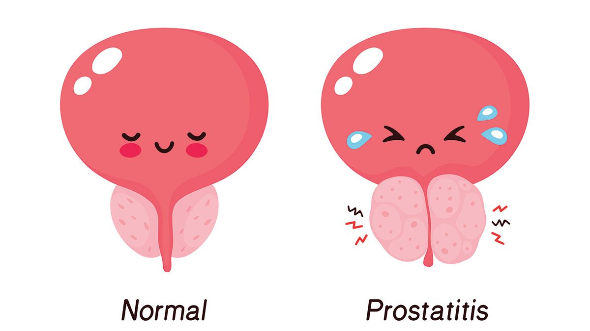L’hypertrophie bénigne de la prostate