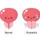 L’hypertrophie bénigne de la prostate