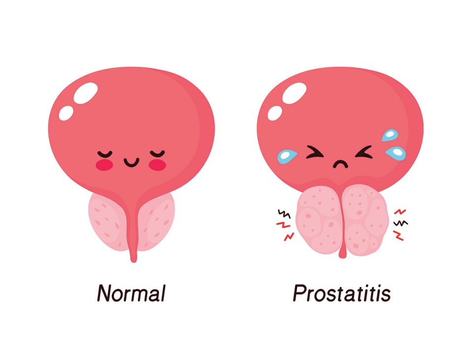 L’hypertrophie bénigne de la prostate