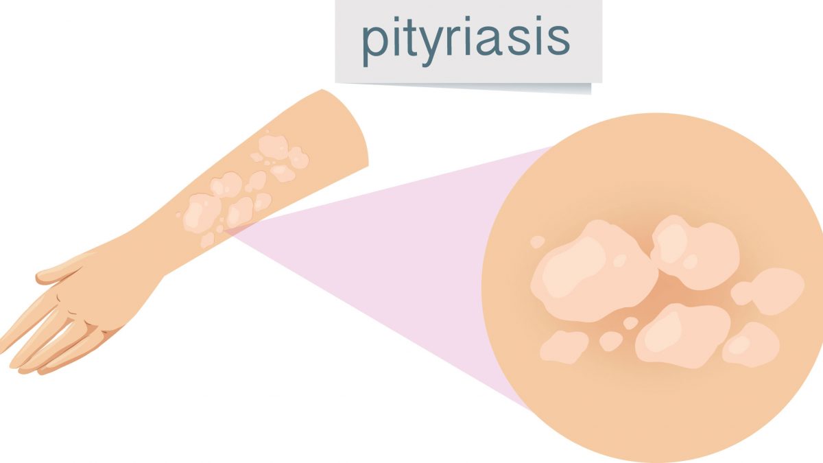 pityriasis rosé de Gibert