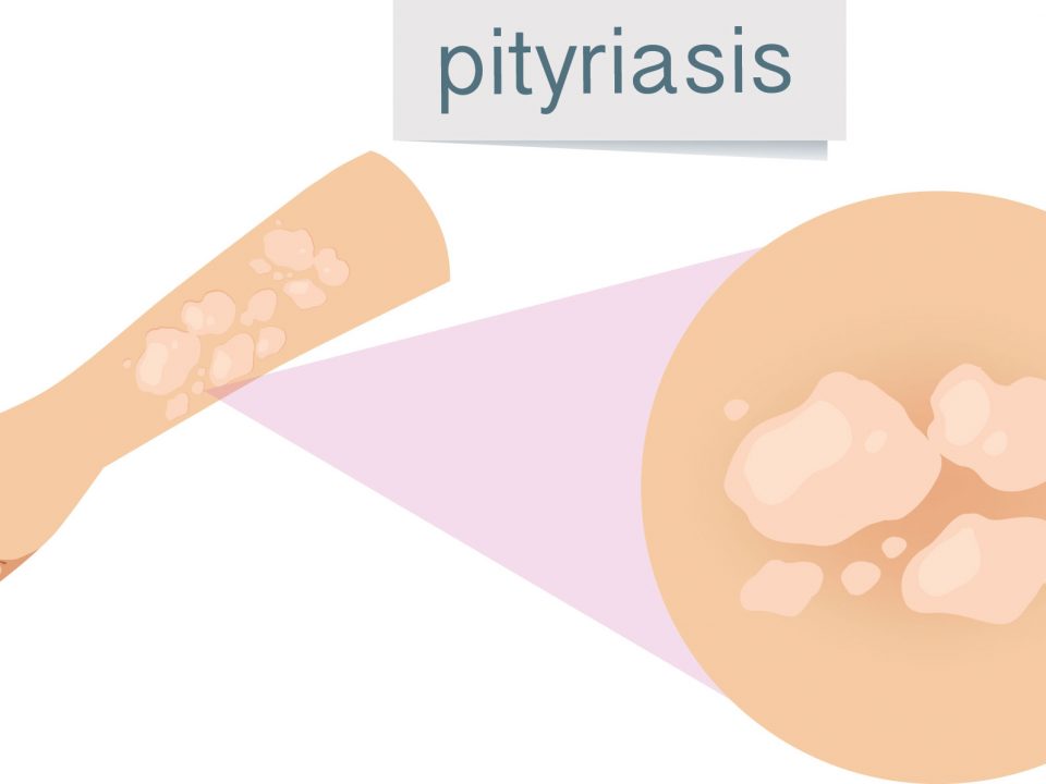 pityriasis rosé de Gibert