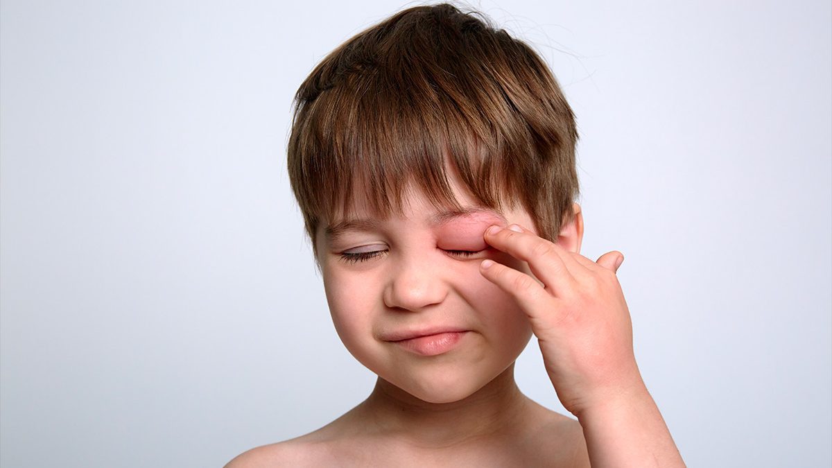 Jeune garçon souffrant d'un Oedème de Quincke avec un oeil très gonflé