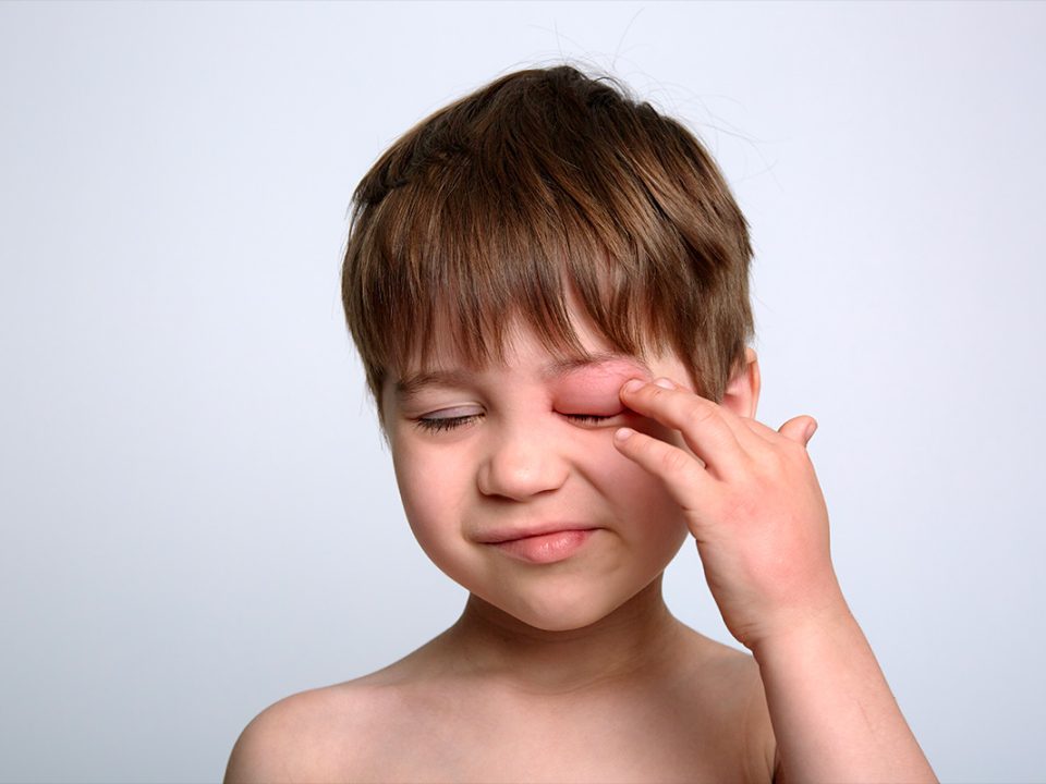 Jeune garçon souffrant d'un Oedème de Quincke avec un oeil très gonflé
