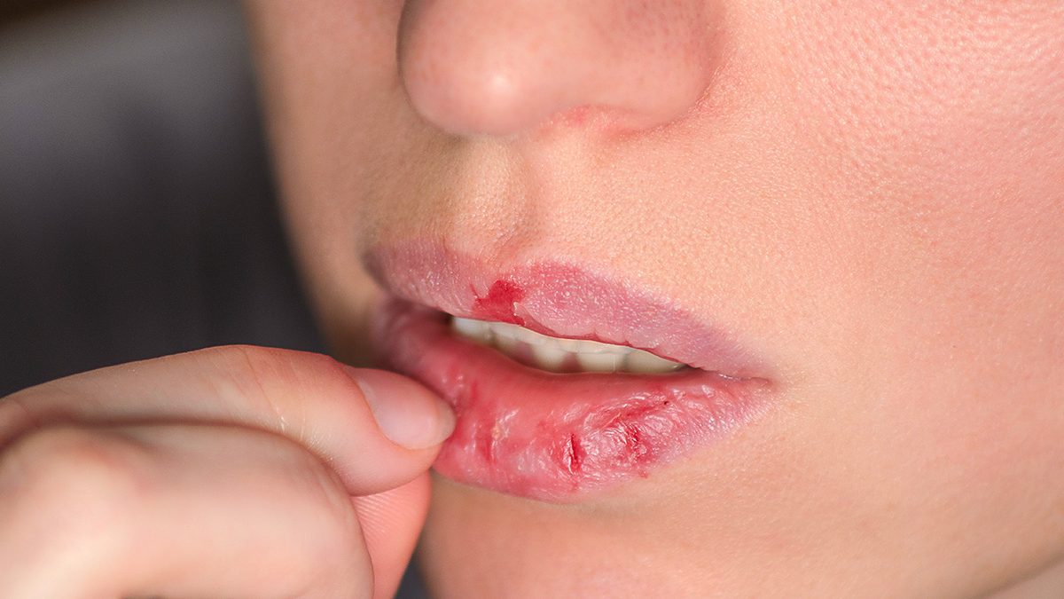 jeune femme atteinte de Dermatillomanie et se mutilant les lèvres