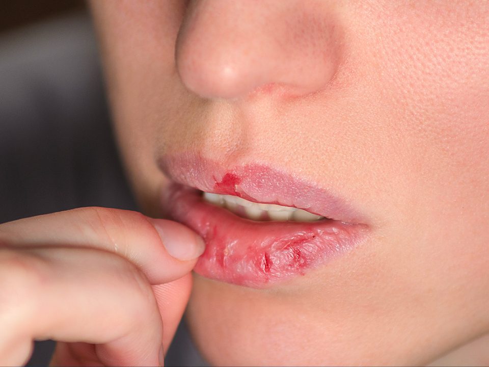 jeune femme atteinte de Dermatillomanie et se mutilant les lèvres