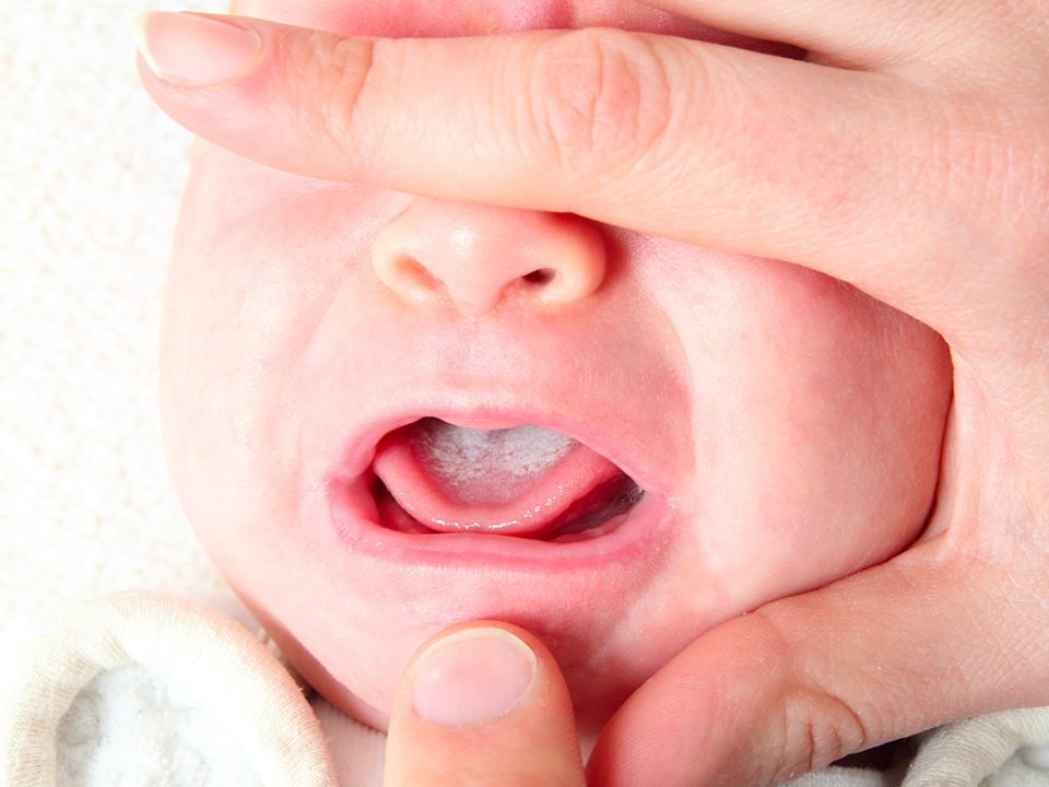 Bébé présentant une langue très blanche à cause du muguet du bébé